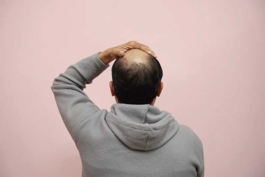 Can Hair Transplant Be the Permanent Baldness Cure You’ve Been Looking For?